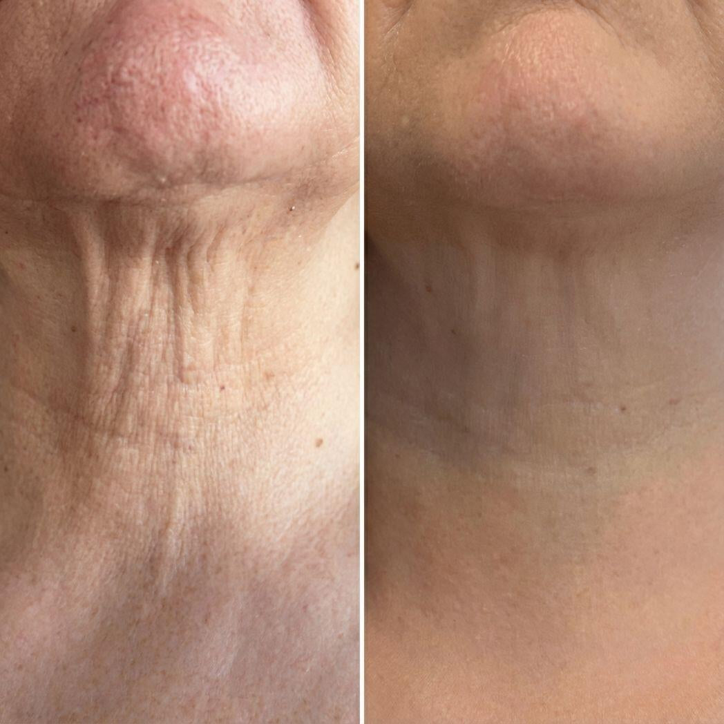 Neck Sculpt - Crema Reafirmante de Cuello con Masajeador 3D Anti-Edad